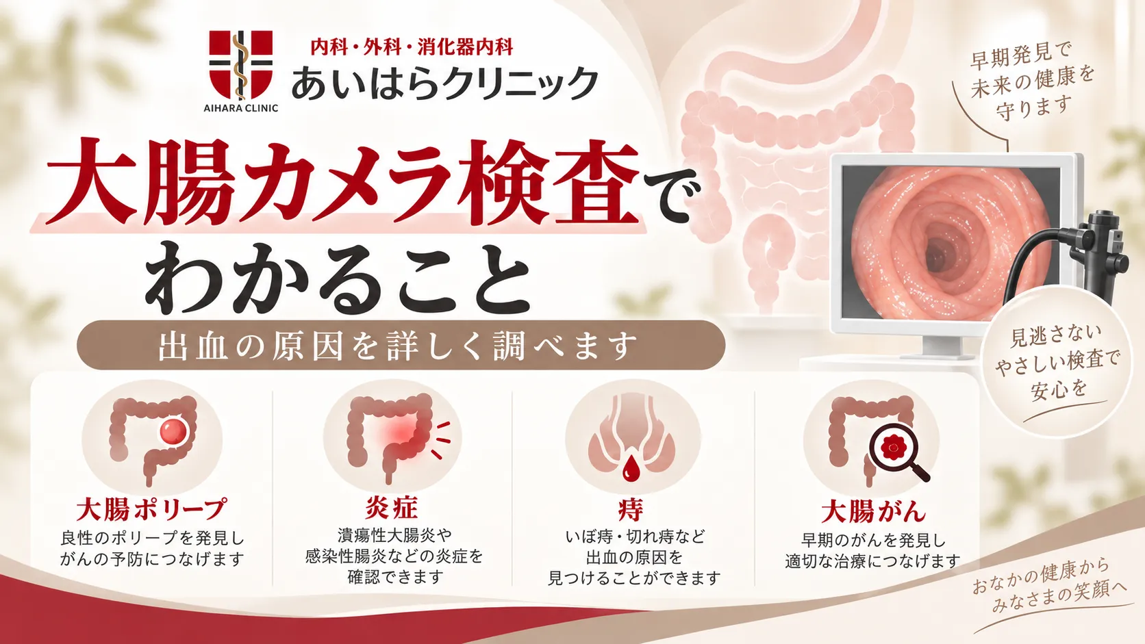 大腸カメラ検査で調べる内容として、大腸ポリープ・炎症・痔・大腸がんを示し、大腸と内視鏡モニターのイラストを添えた図。